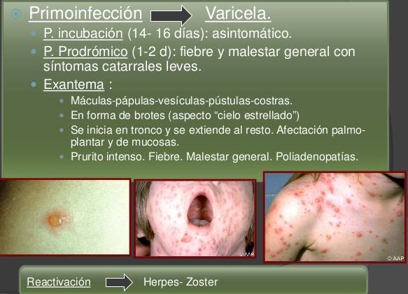 varicela1